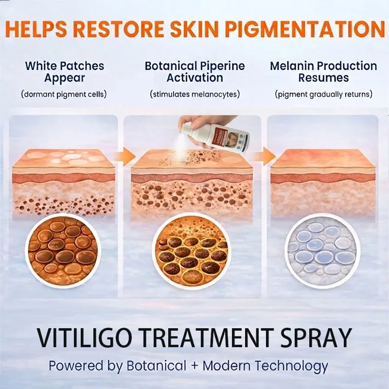 Sylovona Glow Vitiligo Treatment Spray