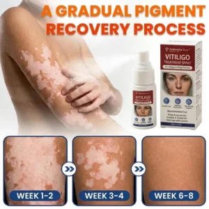 Sylovona Glow Vitiligo Treatment Spray