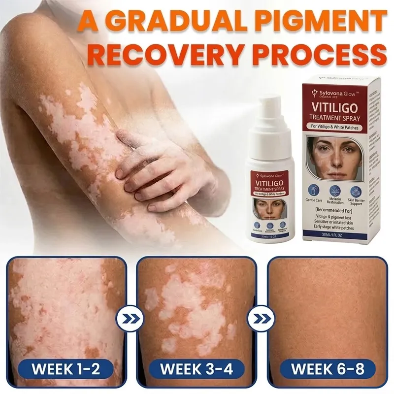 Sylovona Glow Vitiligo Treatment Spray