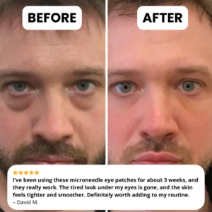 Novelia – Microneedle Patches