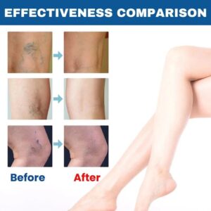 BioEquis Varicose Vein Solution Spray