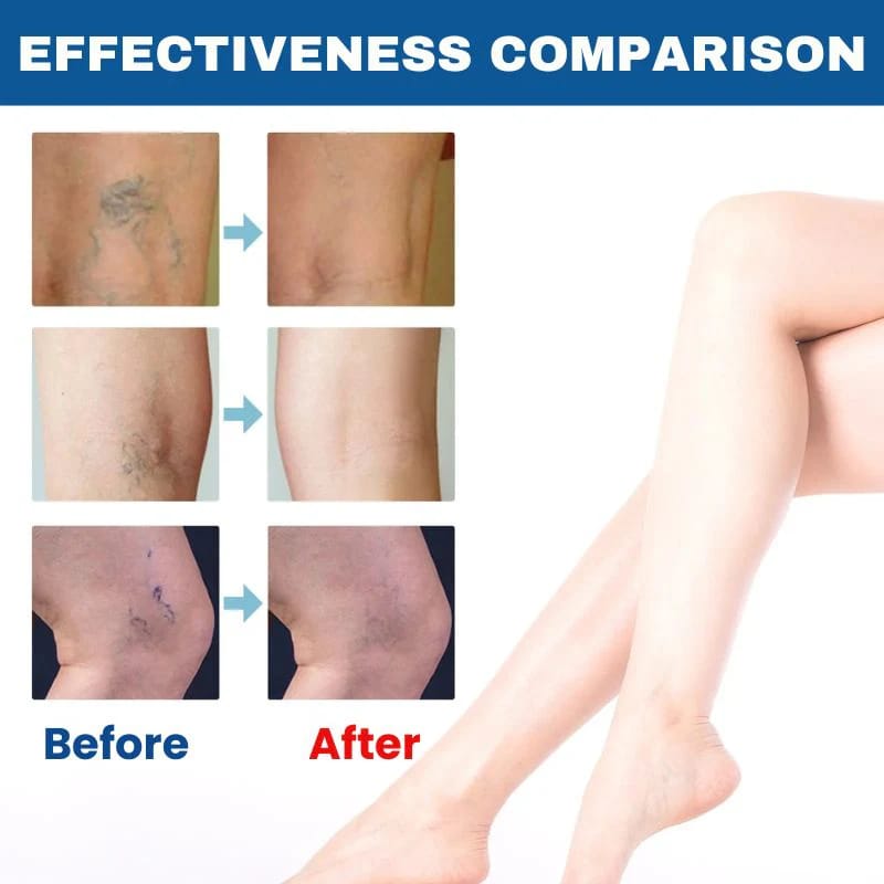 BioEquis Varicose Vein Solution Spray